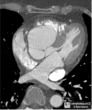 Sinus of Valsalva Aneurysm